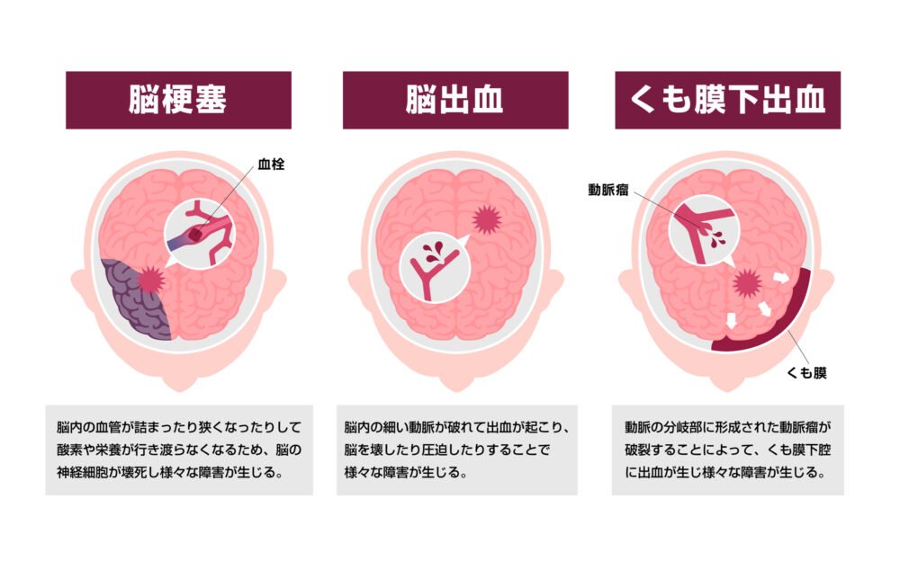 脳卒中 脳梗塞 脳出血 くも膜下出血 違い