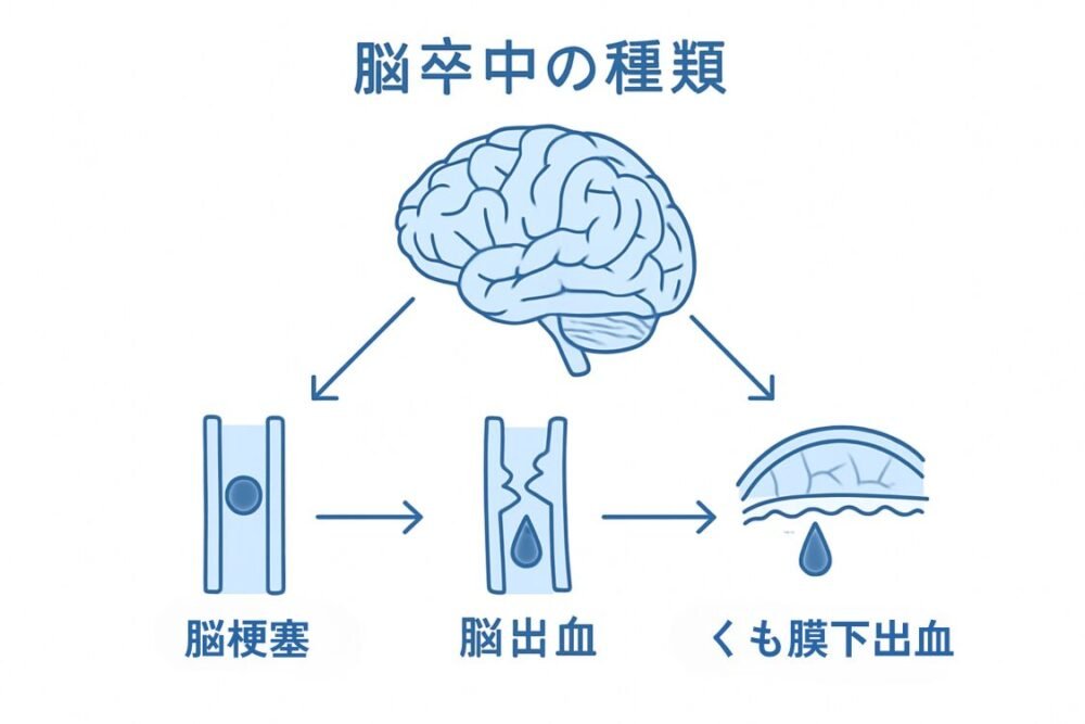 脳卒中 予防